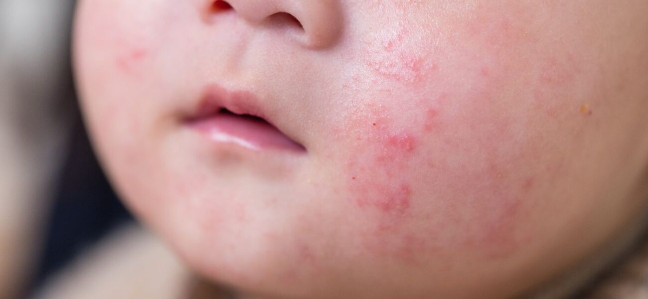 pediatric-skin-concern-sub-banner-1