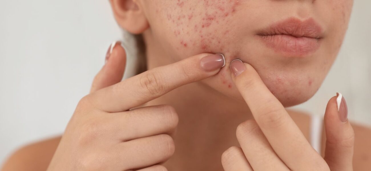acne-scar-treatment-sub-banner-1