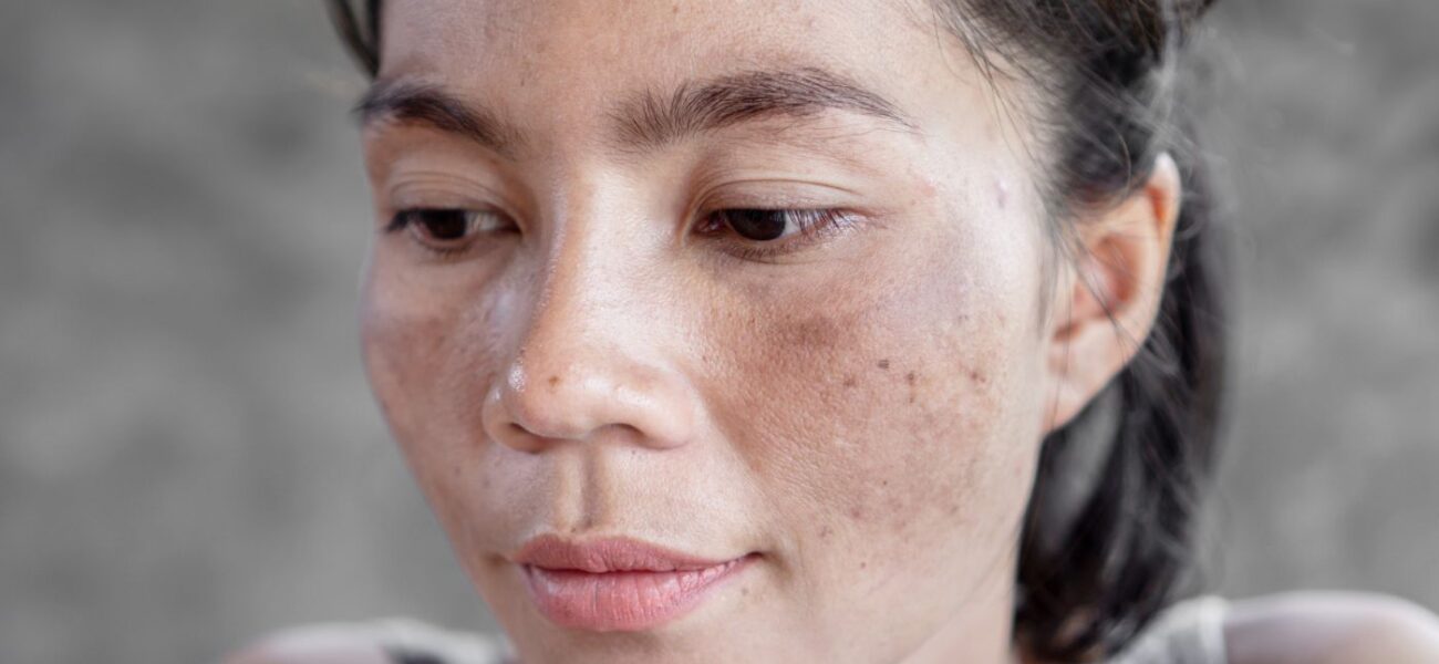 pigmentation-melasma-sub-banner-1