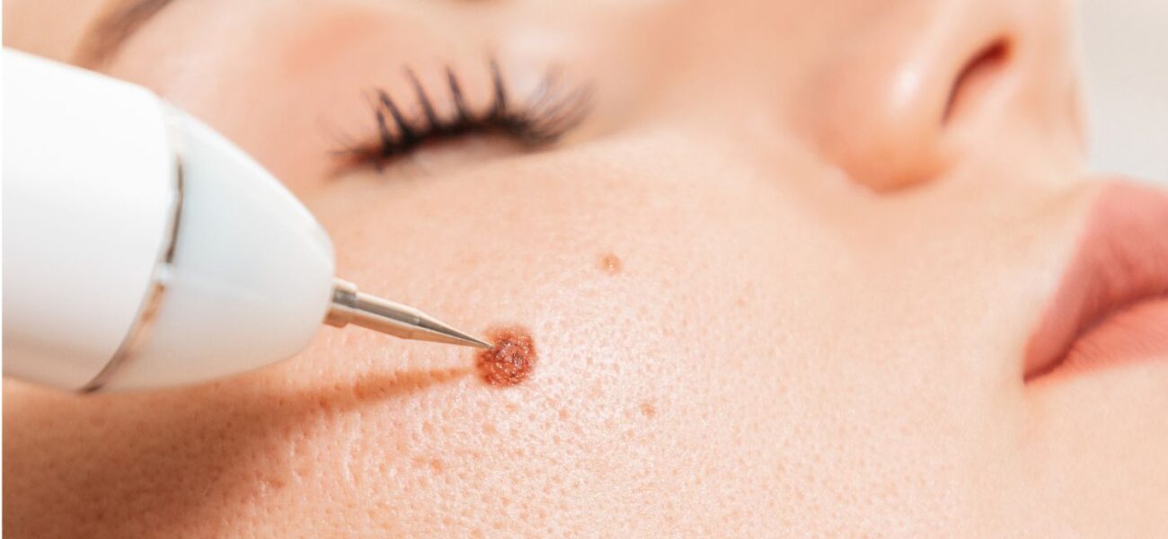 skin-tag-sub-banner-1